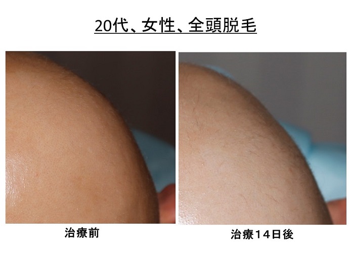 円形脱毛症　病院